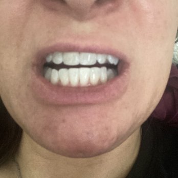 Sarah Amirani, DDS - The next day! Natural light! - General Dentistry Near Me - Los Angeles, California Sarah Amirani, DDS - The next day! Natural light! - General Dentistry Near Me - Los Angeles, California