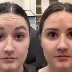 Belleza Med Spa and Clinic - Botox