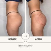 Does Vacuum Butt Lift Work: Truths You Need to Know Now