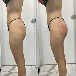 Beyoutifull Body - Non invasive Butt Lift