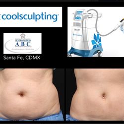 Dr. Rodrigo Morales de la Cerda - Coolsculpting. Non-invasive fat elimination.