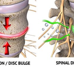 Meridian Integrative Wellness - Sciatica Decompression Treatment