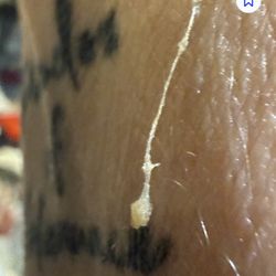 Epiphany Dermatology - That is clearly not a keratin plug.