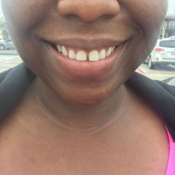 Naturally White Humble - Before - Teeth Whitening Near Me - Atascocita, Texas Naturally White Humble - Before - Teeth Whitening Near Me - Atascocita, Texas