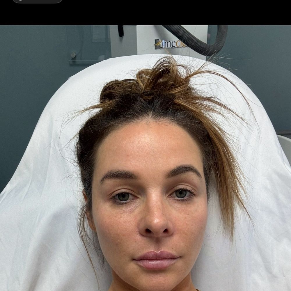 Ranch & Coast Plastic Surgery | Dr. Paul Chasan - Post op 5 months. - Medical Spas Near Me - Del Mar, California Ranch & Coast Plastic Surgery | Dr. Paul Chasan - Post op 5 months. - Medical Spas Near Me - Del Mar, California