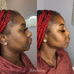 Akeso Aesthetics & Wellness - JAWLINE
