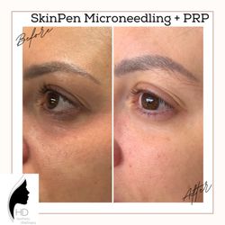 HD Aesthetic Wellness - PRP & microneedling