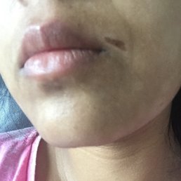 Aftermath of being waxed by an unprofessional at salon soleil.
