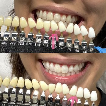 Naturally White - Sugarland - I started at S12 and lifted to S8 by the end of my session. The tech told me I would lift to S6 within the next day! - Teeth Whitening Near Me - Sugar Land, Texas