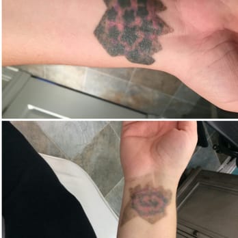 Bare Tattoo Hair Removal 33 Photos 34 Reviews Tattoo