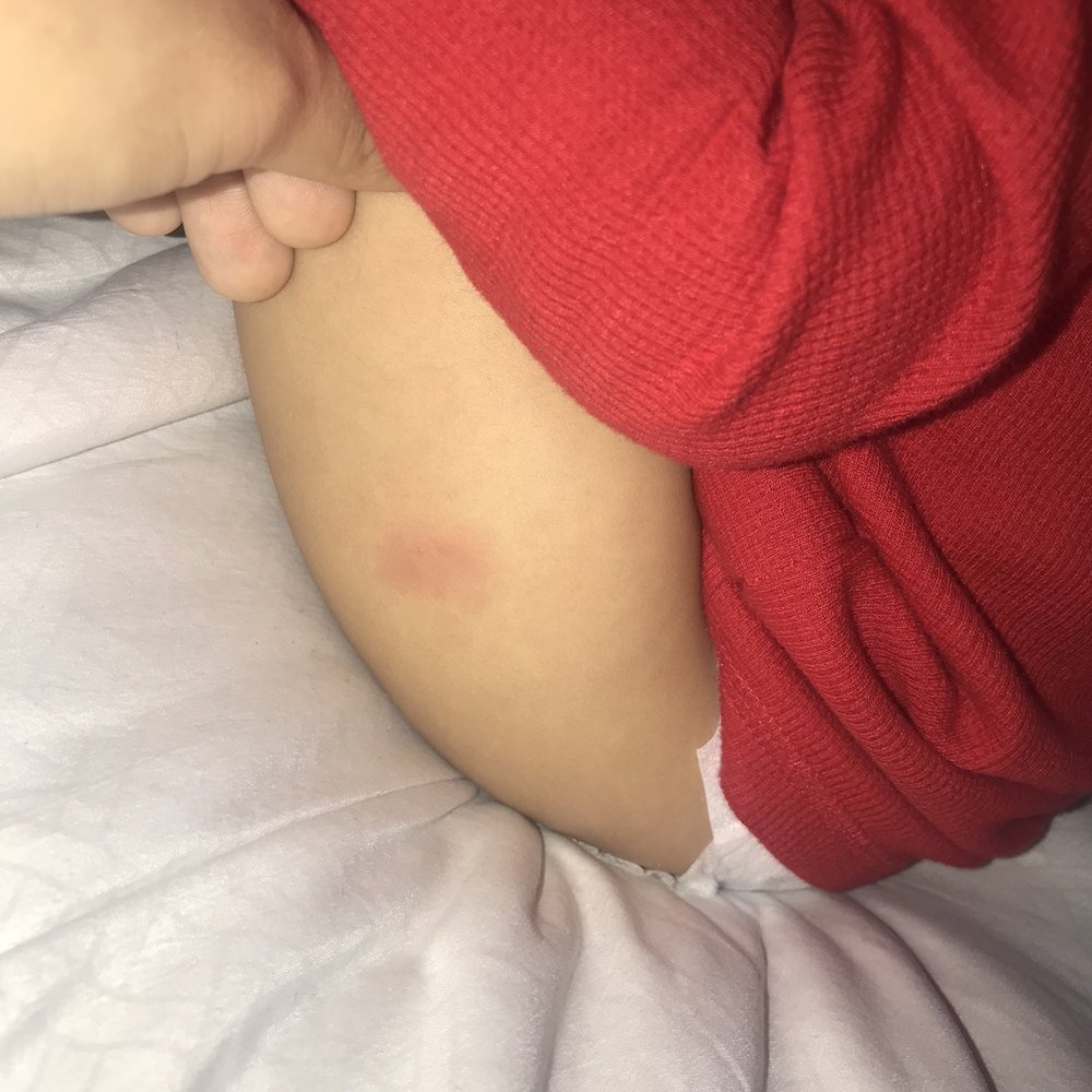 California Pediatrics - Two weeks after the vaccines were given, area was still red and slightly bumpy where needle was inserted - Pediatricians Near Me - San Marcos, California