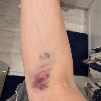 Ringpfeil Advanced Dermatology - Bruising from PRP blood draw - Dermatologists Near Me - Philadelphia, Pennsylvania Ringpfeil Advanced Dermatology - Bruising from PRP blood draw - Dermatologists Near Me - Philadelphia, Pennsylvania