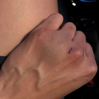 The Hitting Zone - Bruise and cut after getting hit by a fastpitch baseball eventhough i asked for slowpitch softball with arch - Batting Cages Near Me - Santa Fe Springs, California The Hitting Zone - Bruise and cut after getting hit by a fastpitch baseball eventhough i asked for slowpitch softball with arch - Batting Cages Near Me - Santa Fe Springs, California