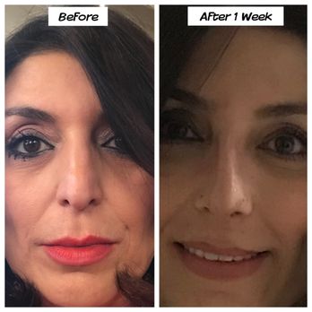 Boris M. Ackerman, MD - Cosmetic Surgeons Near Me - Newport Beach, California Boris M. Ackerman, MD - Cosmetic Surgeons Near Me - Newport Beach, California