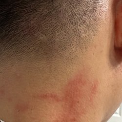 Inspired Cuts - Cut burn and rash after cut