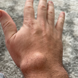 Big Ganglion!!! Big Ganglion!!!
