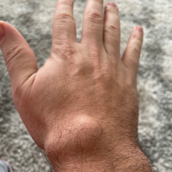Lauchlan Chambers, MD, MPH - Big Ganglion!!! - Orthopedists Near Me - Fountain Valley, California Lauchlan Chambers, MD, MPH - Big Ganglion!!! - Orthopedists Near Me - Fountain Valley, California