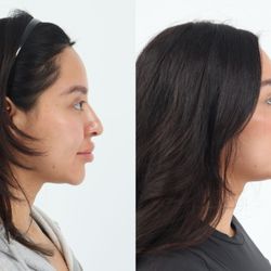 Madnani Facial Plastics - Before and 6 weeks after Rhinoplasty by Dr. Chouake.