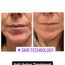 Skin Technology - Anti aging treatment