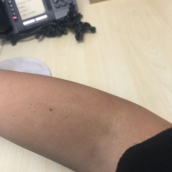 Hangover Heaven - Bruise in my arm 3 days after treatment. This is the arm was not used. - IV Hydration Near Me - Las Vegas, Nevada Hangover Heaven - Bruise in my arm 3 days after treatment. This is the arm was not used. - IV Hydration Near Me - Las Vegas, Nevada