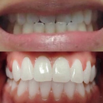 Geer Dental Care - Before and after treatment with Six Month Smiles! Call us today to schedule your free consultation at 209-667-2216 :) - General Dentistry Near Me - Turlock, California Geer Dental Care - Before and after treatment with Six Month Smiles! Call us today to schedule your free consultation at 209-667-2216 :) - General Dentistry Near Me - Turlock, California