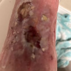 A to Z Dermatology - My leg after going to A to Z dermatology