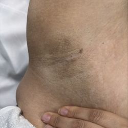 Bare Sugar Beauty - Underarms Before
