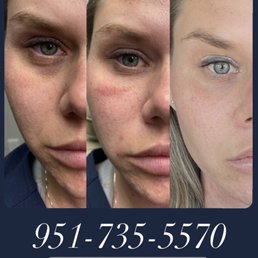 PRP therapy combined with a small amount of filler. Amazing results !