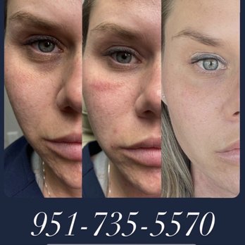 Skin Theory - PRP therapy combined with a small amount of filler. Amazing results ! - Laser Hair Removal Near Me - Corona, California