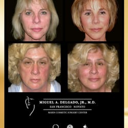 Miguel Delgado, M.D - Facelift Surgery- full facelift, mini-facelift, neck lift, mommy makeover, tummy tuck surgery. Marin, Sonoma County, Napa, Santa Rosa