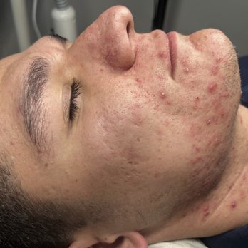 Comfort Zone Esthetics - 2 weeks after initial appointment- client saw drastic improvement - Acne Treatment Near Me