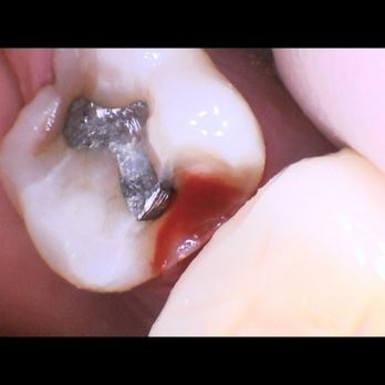 GLOW Dental - This is after the second dentist removed the horrible filling and when I had infection. Was made with cheaper materials. - Cosmetic Dentists Near Me - Orange, California
