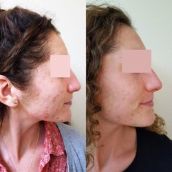 Proderma Acne Treatment Systems for Teens