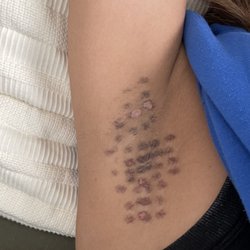 Medical Cosmetic Enhancements - Laser Hair Removal Burn