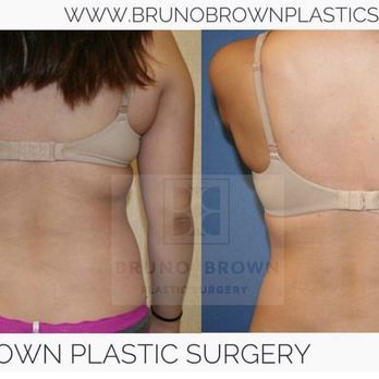 Bruno Brown Plastic Surgery - SmartLipo results on a patients flanks - Medical Spas Near Me - Chevy Chase, Maryland