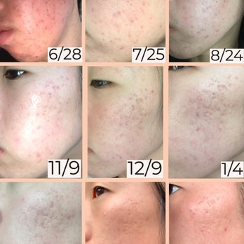 La Jolla Acne Specialists - Progression of skin improvement throughout a year span - Acne Treatment Near Me - San Diego, California La Jolla Acne Specialists - Progression of skin improvement throughout a year span - Acne Treatment Near Me - San Diego, California