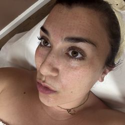 Noble Beauty Center - Microneedling results