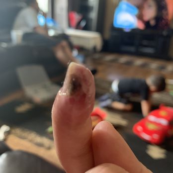 Diva Nails - May 19th after finger tip fell off and infected area - Nail Salons Near Me - Chula Vista, California