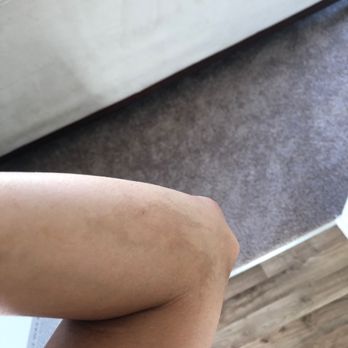 Pamper Yourself With Karuna - 1 week later I still have significant burn marks on various parts of my arms and legs. - Skin Care Near Me - Fremont, California
