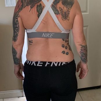 Nazih M Haddad, MD - Week after so called bbl lipo of love handles, flanks, lower/upper back lower/upper stomach. I look just like my before - Cosmetic Surgeons Near Me - Newport Beach, California Nazih M Haddad, MD - Week after so called bbl lipo of love handles, flanks, lower/upper back lower/upper stomach. I look just like my before - Cosmetic Surgeons Near Me - Newport Beach, California