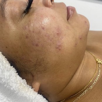 Armenta Skin - Skin Care Near Me - Pacoima, California Armenta Skin - Skin Care Near Me - Pacoima, California