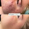 Acne Clinic gift card
