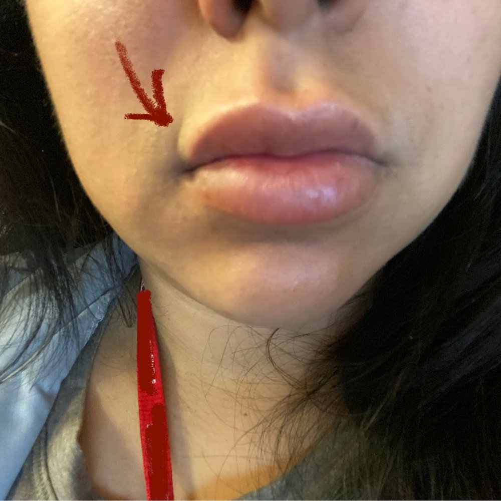 Lazer Lounge - The crease developed from the filler. There's no filler on the sides just my Cupid's bow. - Laser Hair Removal Near Me - Studio City, California Lazer Lounge - The crease developed from the filler. There's no filler on the sides just my Cupid's bow. - Laser Hair Removal Near Me - Studio City, California