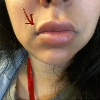 Lazer Lounge - The crease developed from the filler. There's no filler on the sides just my Cupid's bow. - Laser Hair Removal Near Me - Studio City, California