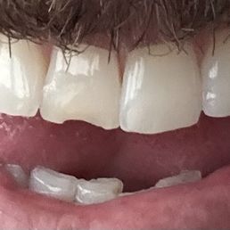 Chipped tooth, previously fixed multiple times. Chipped tooth, previously fixed multiple times.