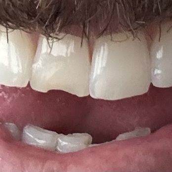 Uno Dental - Chipped tooth, previously fixed multiple times. - General Dentistry Near Me - San Francisco, California Uno Dental - Chipped tooth, previously fixed multiple times. - General Dentistry Near Me - San Francisco, California