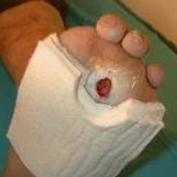 Doctor De Los Pies - Sufre de diabetis y tiene callosidades visite a su doctor de los pies antes de vuelva ulcera diabetica
