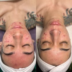Calysta - Before & After  client came in with cystic Acne & scaring these are results after just 3 sessions of Hydrofacial & LED Therapy