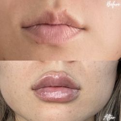 Advanced Aesthetics - Lip fillers