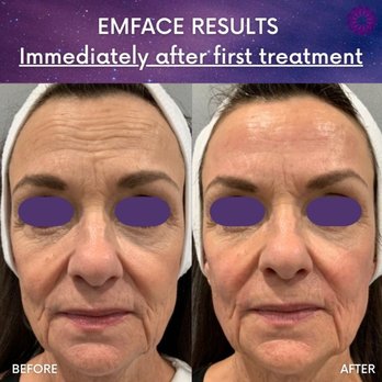 Glow Medispa - Kirkland - EMFACE Results! How Incredible! - Medical Spas Near Me - Kirkland, Washington Glow Medispa - Kirkland - EMFACE Results! How Incredible! - Medical Spas Near Me - Kirkland, Washington